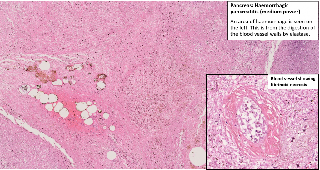 Acute Pancreatitis Histology