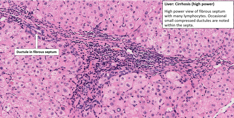 Liver – Cirrhosis with Hepatocellular Carcinoma – NUS Pathweb :: NUS ...