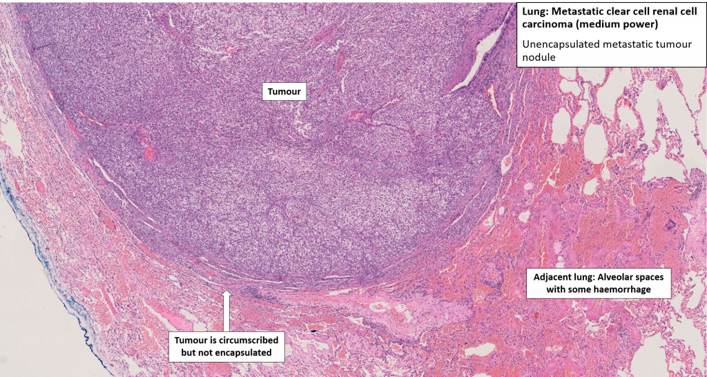 Lung – Metastatic Carcinoma – NUS Pathweb :: NUS Pathweb