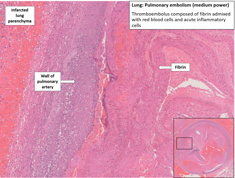 Heart With Lungs – Thromboembolism – NUS Pathweb :: NUS Pathweb