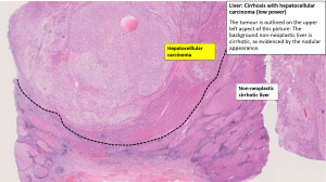 Liver – Cirrhosis With Hepatocellular Carcinoma – NUS Pathweb :: NUS ...