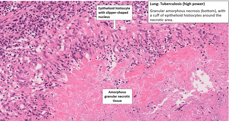 Lung and Lymph Nodes – Tuberculosis with Primary Complex – NUS Pathweb ...