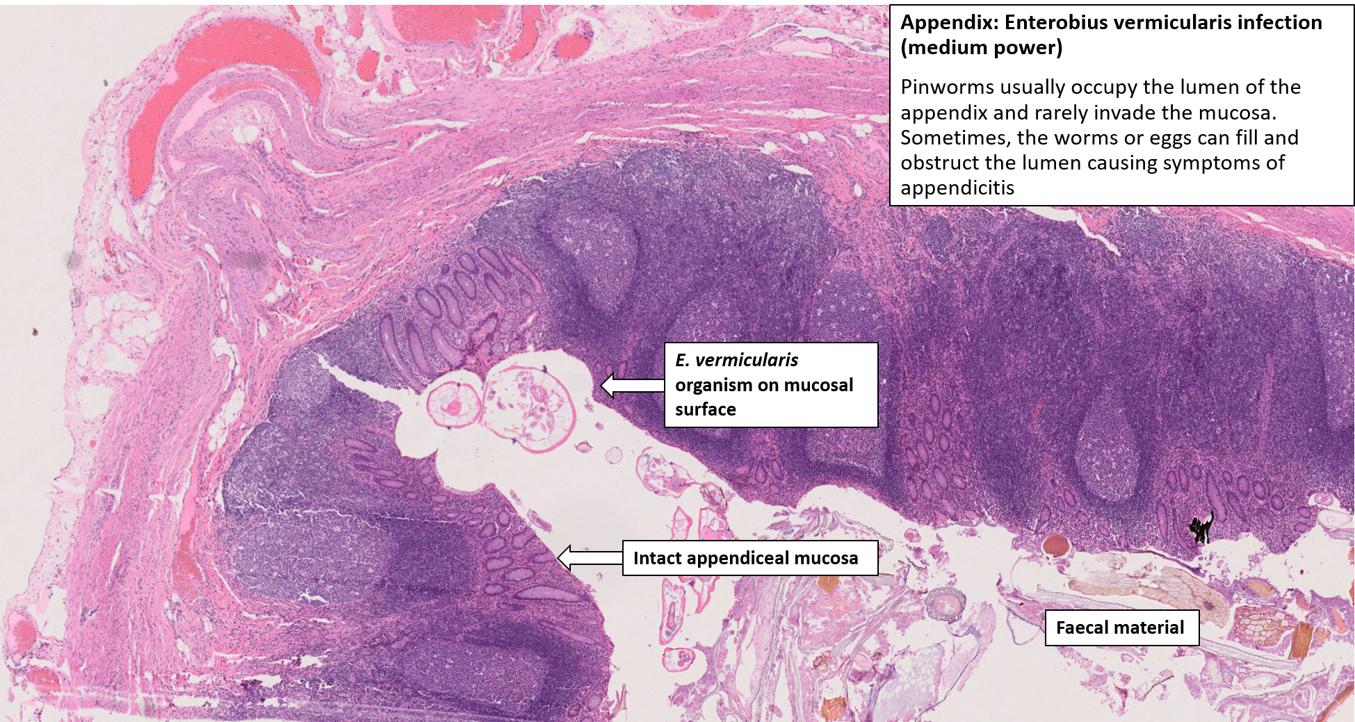 appendicitis histology