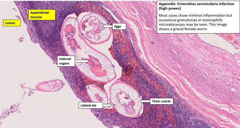 Appendix – Acute Appendicitis – NUS Pathweb :: NUS Pathweb