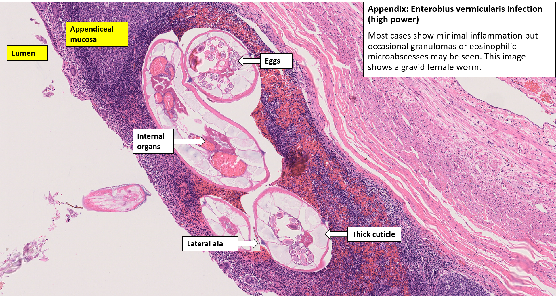 Appendix Acute Appendicitis NUS Pathweb NUS Pathweb Appendix Acute Appendicitis NUS Pathweb NUS Pathweb