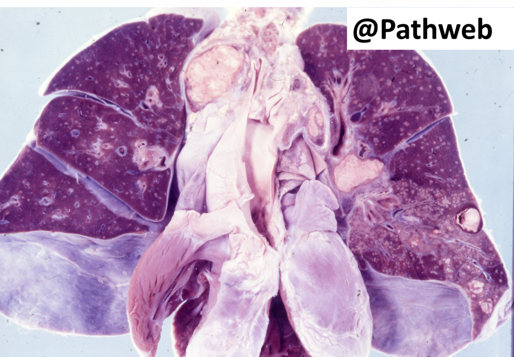 Lung – Tuberculosis with Cavitation – NUS Pathweb :: NUS Pathweb