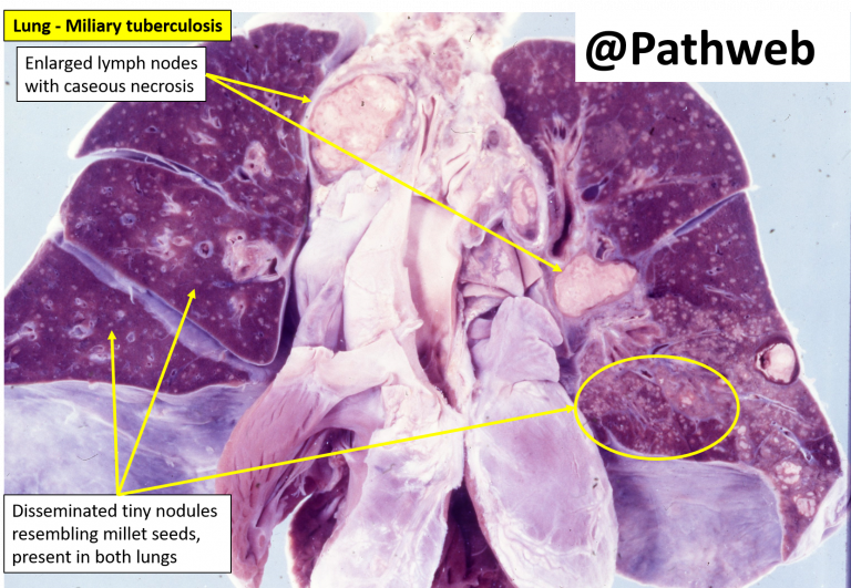 Lung Tuberculosis With Cavitation Nus Pathweb Nus Pathweb