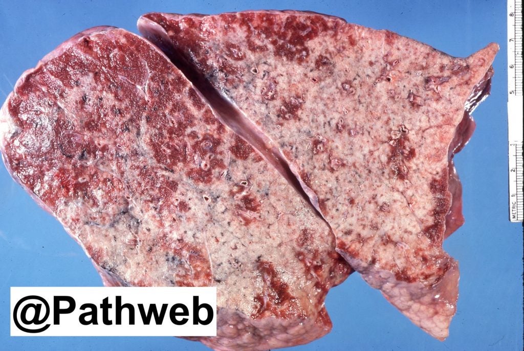 Lung Lobar Pneumonia NUS Pathweb NUS Pathweb