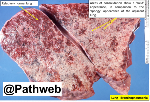 Lung Lobar Pneumonia – NUS Pathweb :: NUS Pathweb