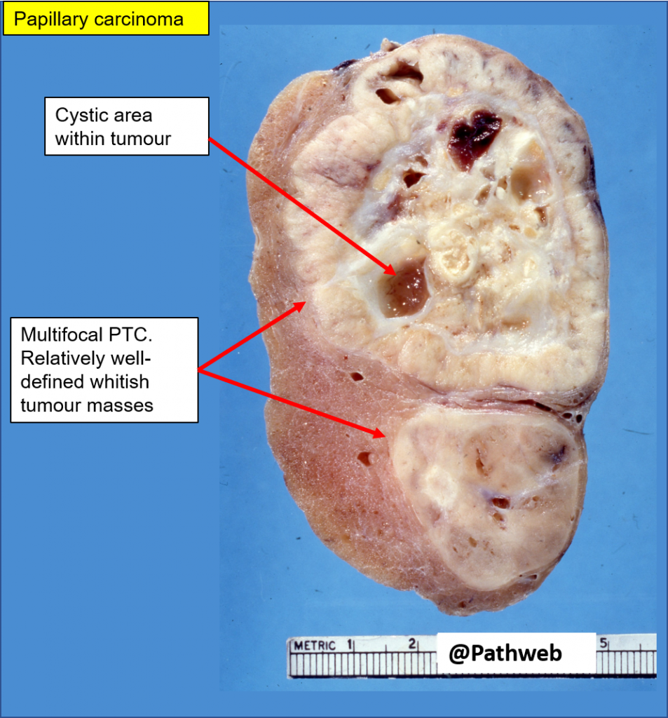 Thyroid Papillary Carcinoma Nus Pathweb Nus Pathweb