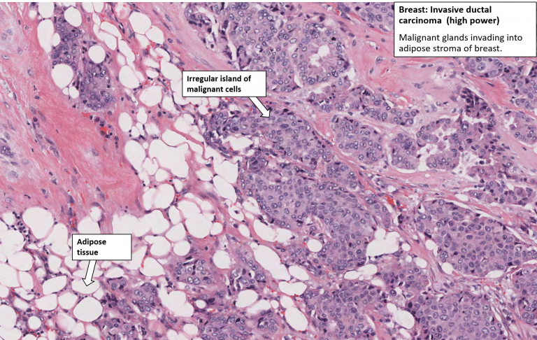 Breast – Carcinoma – NUS Pathweb :: NUS Pathweb