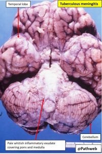 Brain – Tuberculous Meningitis – NUS Pathweb