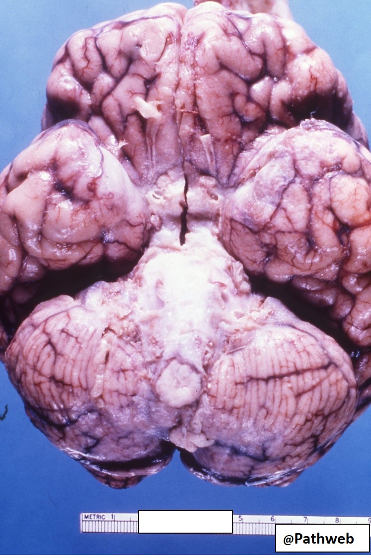 Brain – Tuberculous Meningitis – NUS Pathweb