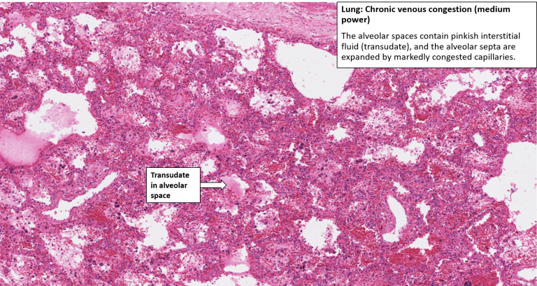 Lung Chronic Venous Congestion Brown Induration NUS Pathweb 