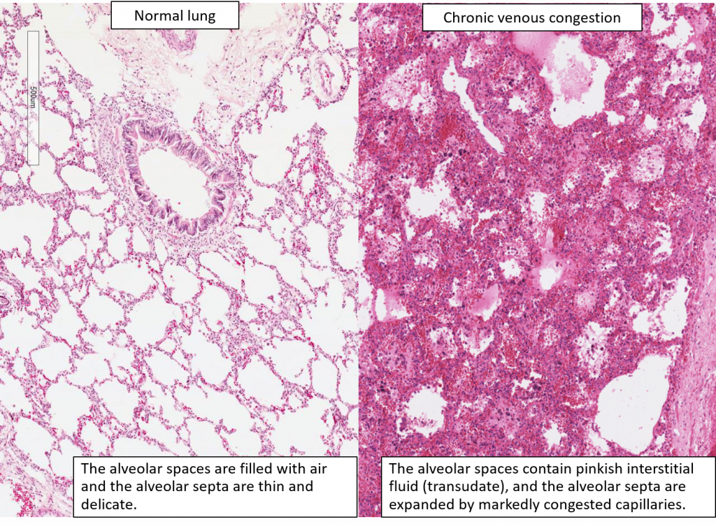 Chronic Venous Congestion Cvc Liver Cvc Lung Cvc Spleen Pathology 