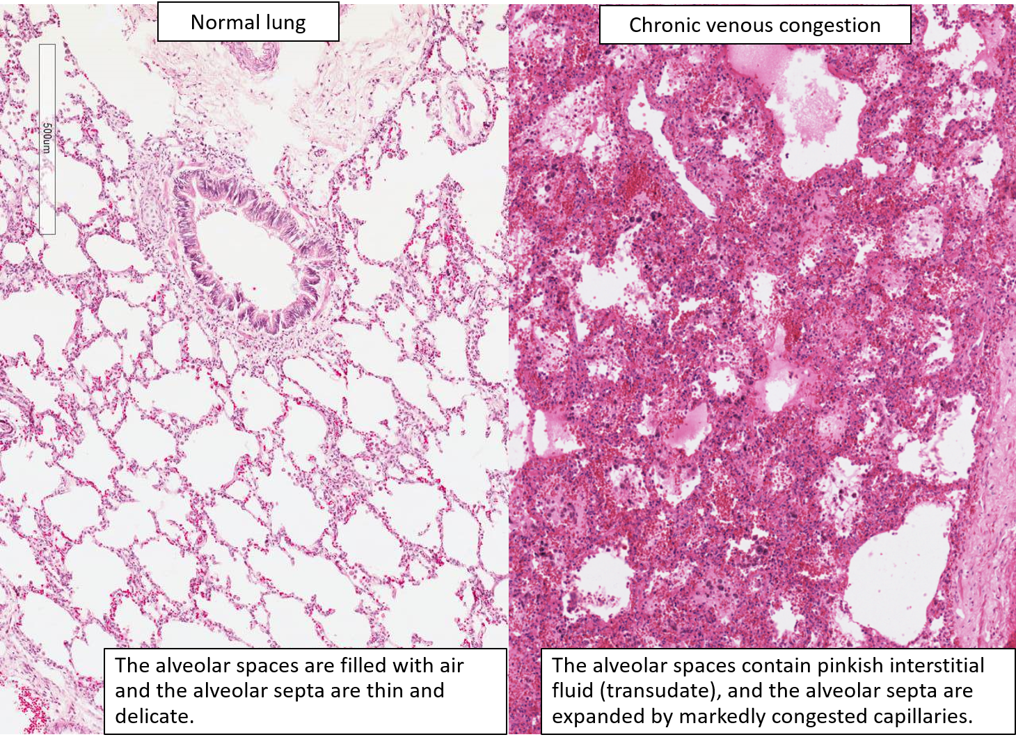 Lung Chronic Venous Congestion Brown Induration NUS Pathweb 