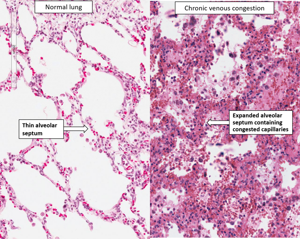Lung Chronic Venous Congestion Brown Induration NUS Pathweb 