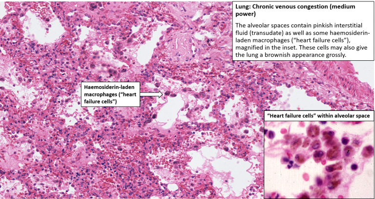 Lung Chronic Venous Congestion Brown Induration NUS Pathweb 