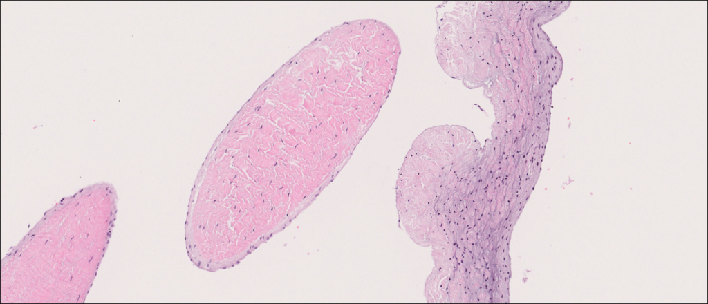 Atrioventricular Valve With Chordae Tendineae Normal Histology Nus