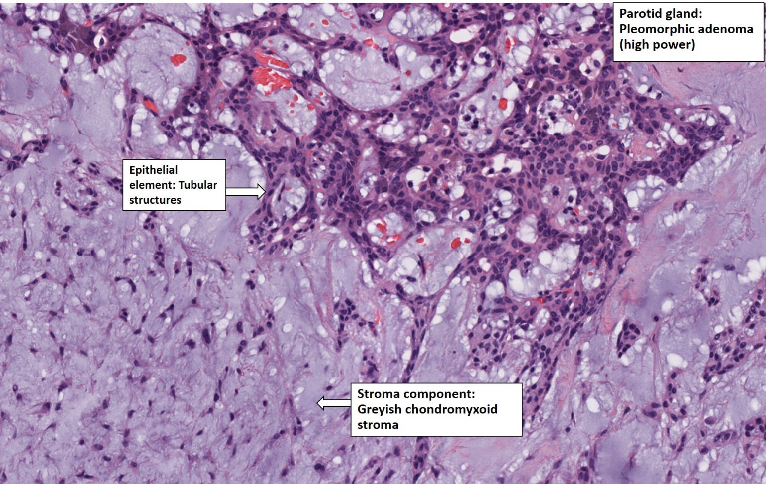 Salivary Gland – Pleomorphic Adenoma – Nus Pathweb :: Nus Pathweb