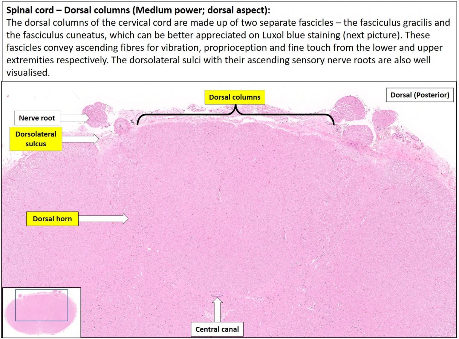 Spinal cord – NUS Pathweb :: NUS Pathweb