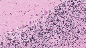 Brain – Cerebellum – NUS Pathweb :: NUS Pathweb