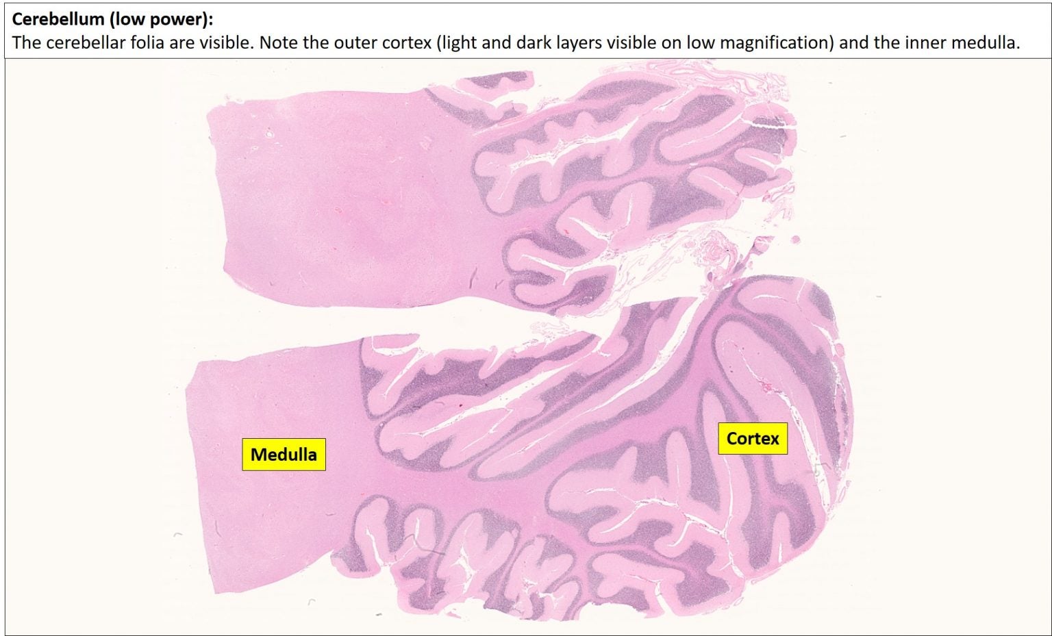 Brain – Cerebellum – NUS Pathweb :: NUS Pathweb