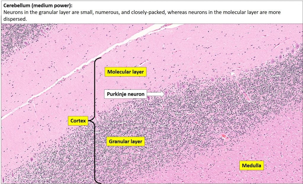 Brain – Cerebellum – NUS Pathweb :: NUS Pathweb