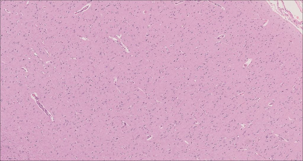 Brain – Cerebrum – NUS Pathweb :: NUS Pathweb