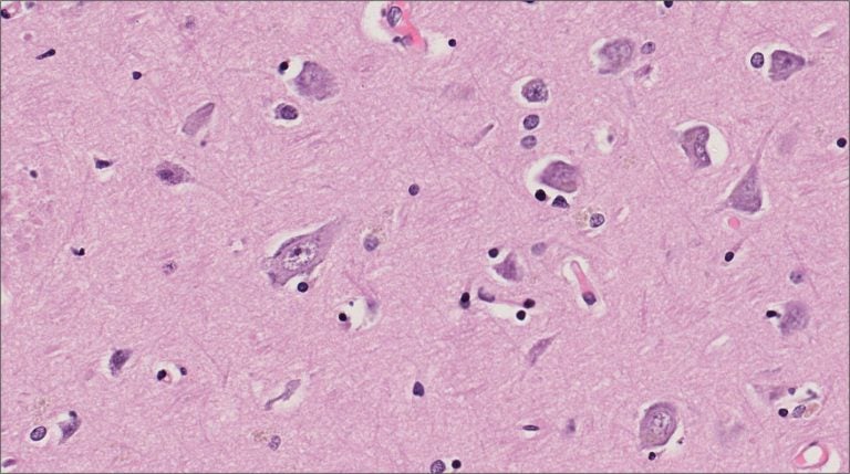 Brain – Cerebrum – NUS Pathweb :: NUS Pathweb