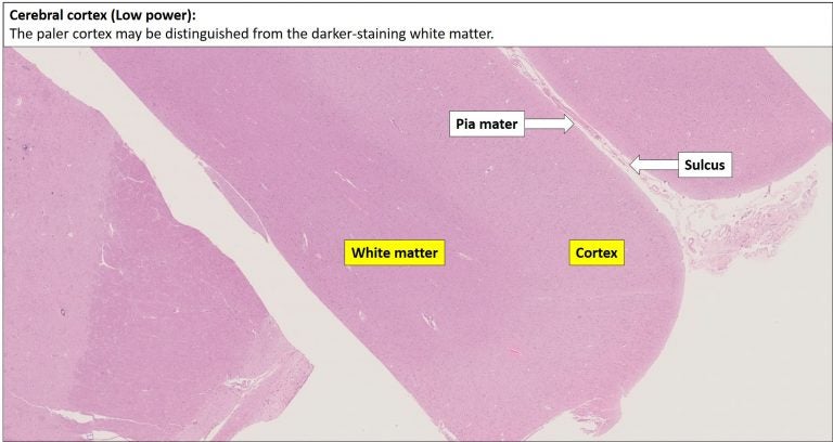 Brain – Cerebrum – NUS Pathweb :: NUS Pathweb