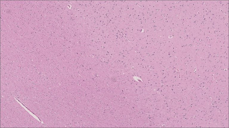 Brain – Cerebrum – NUS Pathweb :: NUS Pathweb