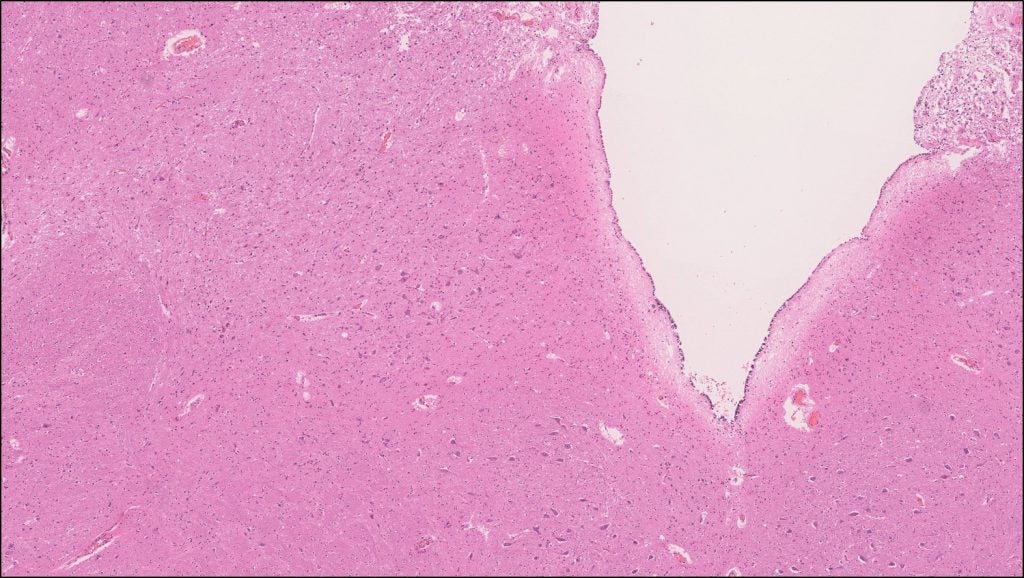 Brain – Medulla – NUS Pathweb :: NUS Pathweb