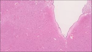 Brain – Medulla – NUS Pathweb :: NUS Pathweb