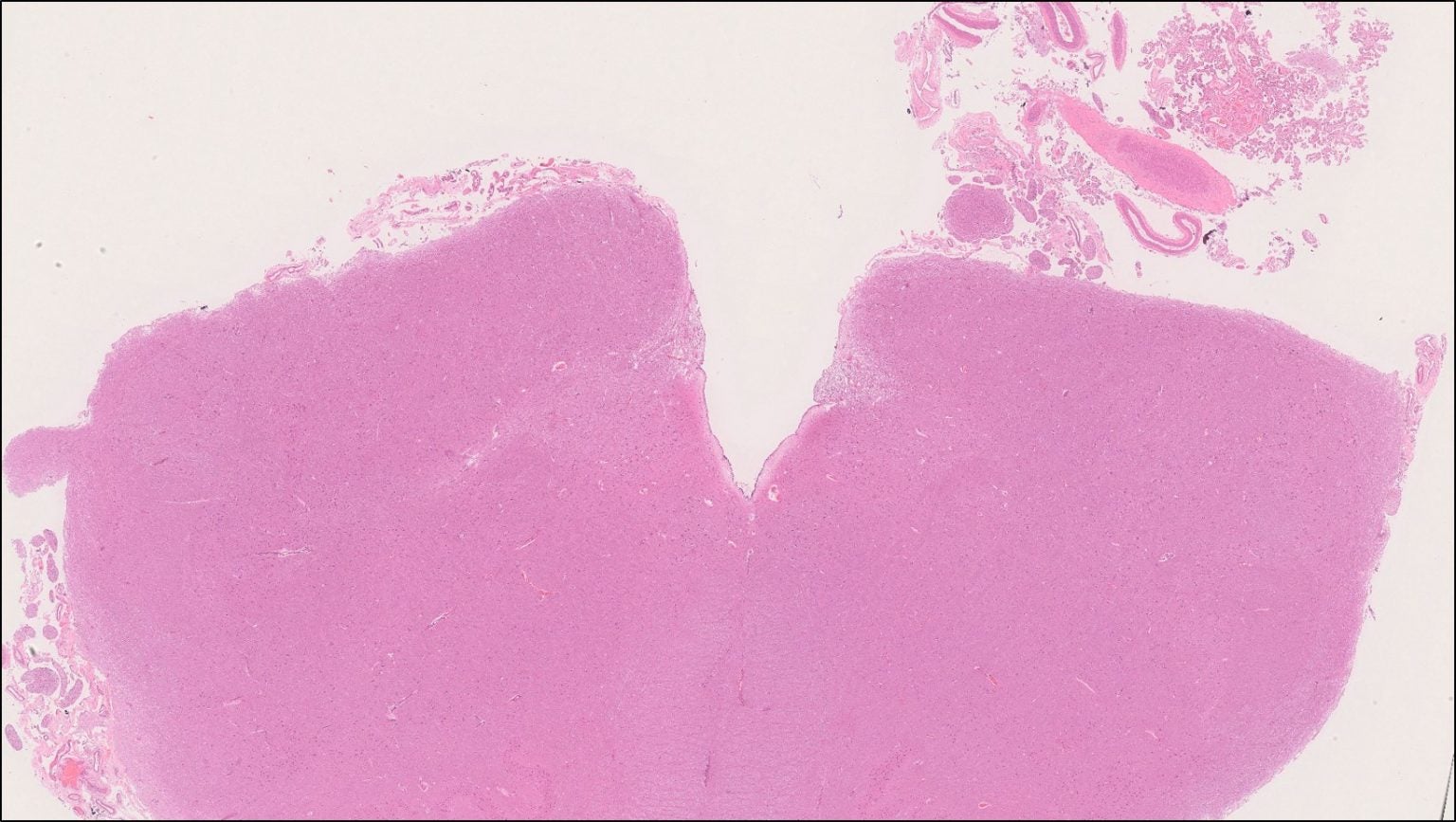 Brain – Medulla – NUS Pathweb :: NUS Pathweb