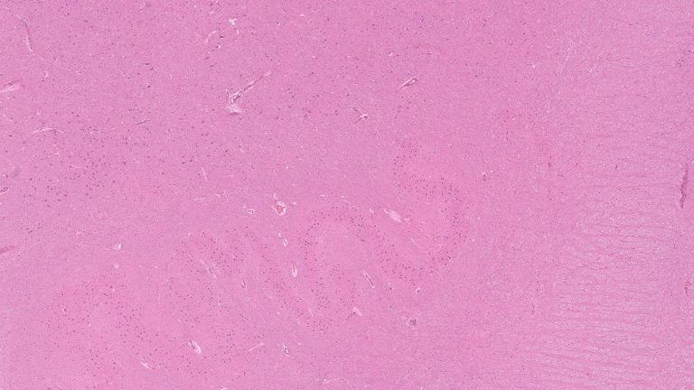 Brain – Medulla – NUS Pathweb :: NUS Pathweb