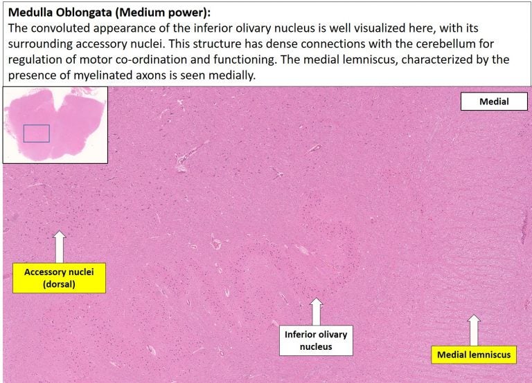 Brain – Medulla – NUS Pathweb :: NUS Pathweb