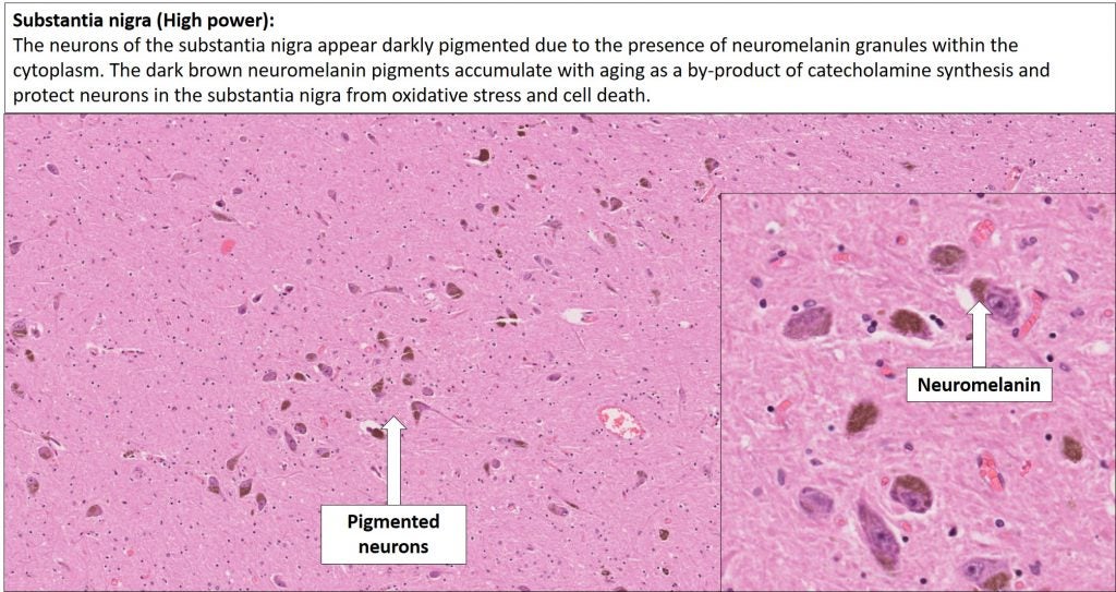 Brain – Midbrain – NUS Pathweb :: NUS Pathweb