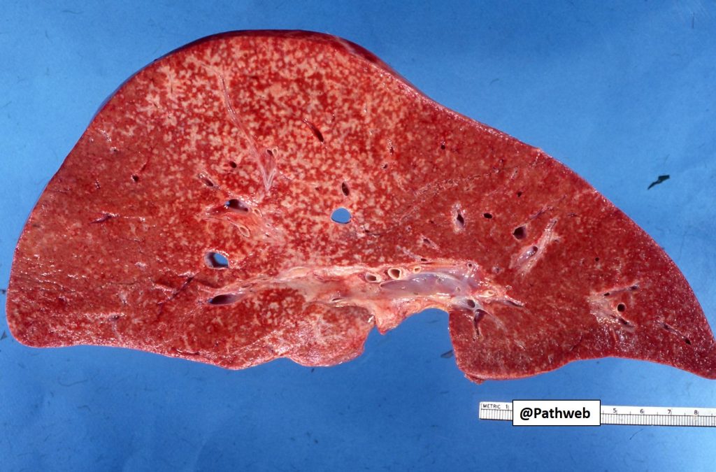 Spleen – Leukaemia – NUS Pathweb :: NUS Pathweb