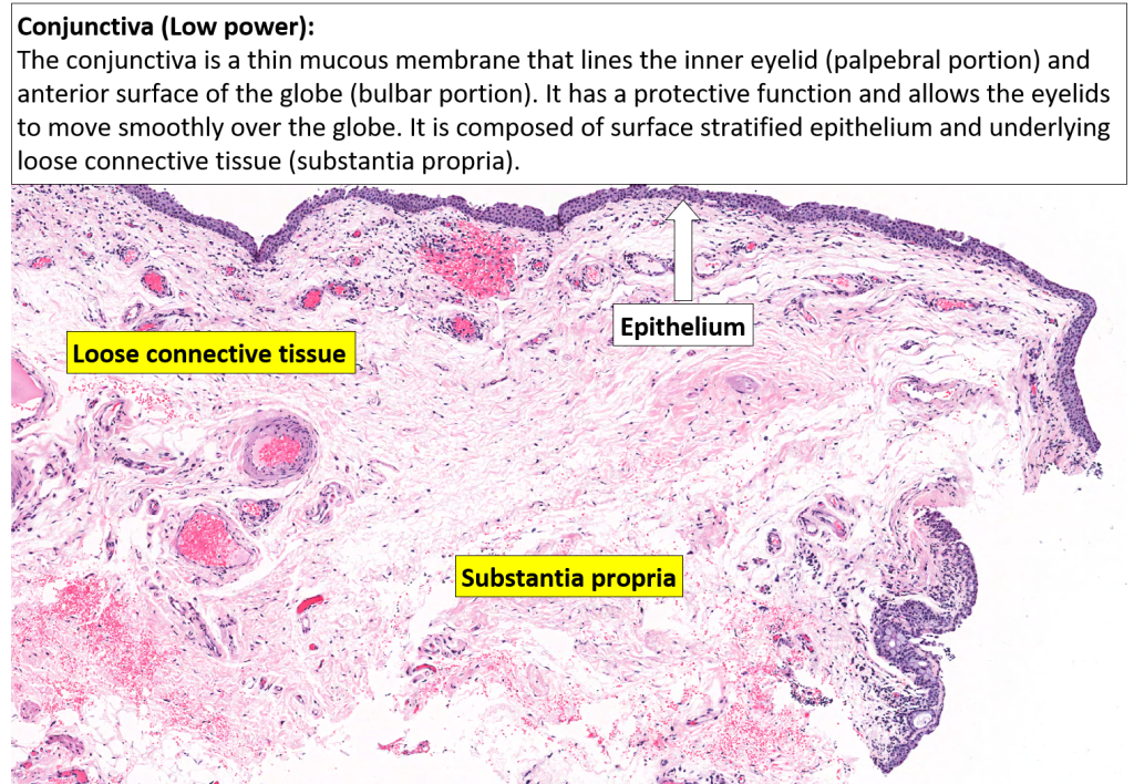 Eye – Conjunctiva – NUS Pathweb :: NUS Pathweb