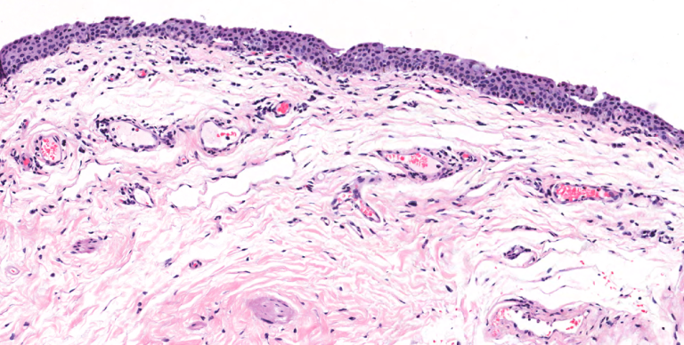 Eye – Conjunctiva – NUS Pathweb :: NUS Pathweb