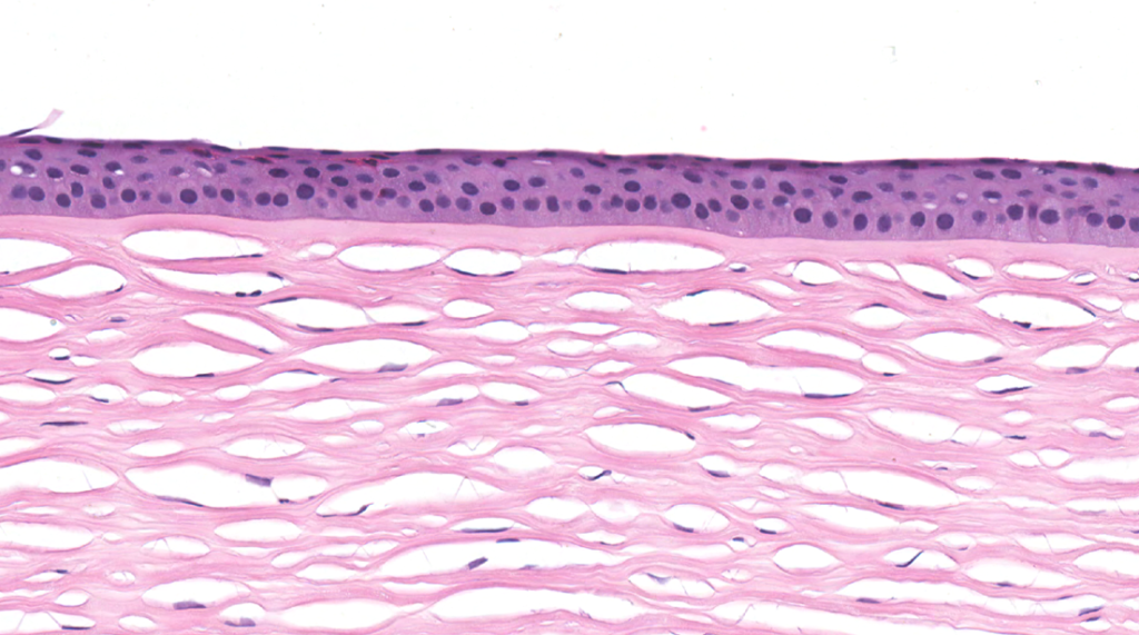 Eye – Cornea – NUS Pathweb :: NUS Pathweb