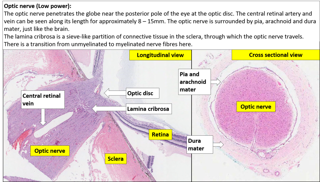 Eye Optic nerve NUS Pathweb NUS Pathweb