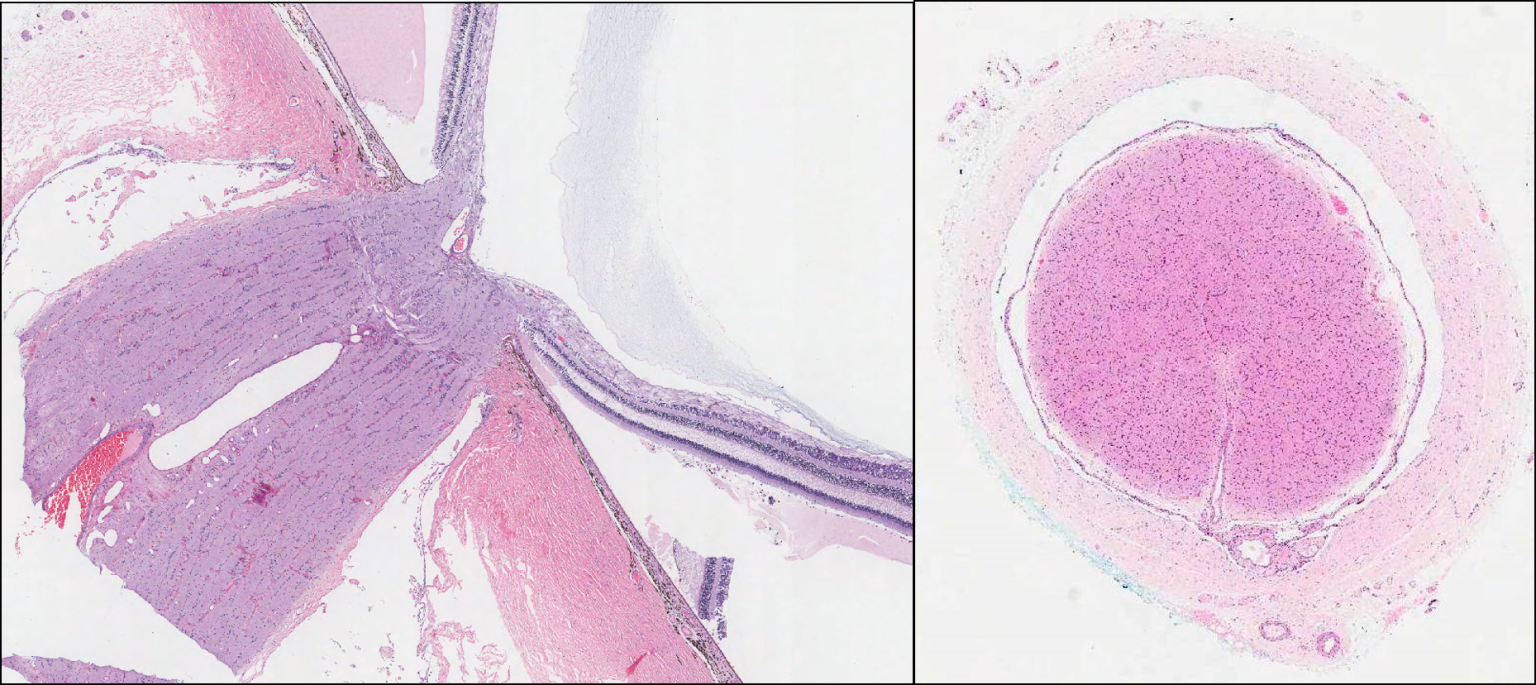 Eye Optic nerve NUS Pathweb NUS Pathweb