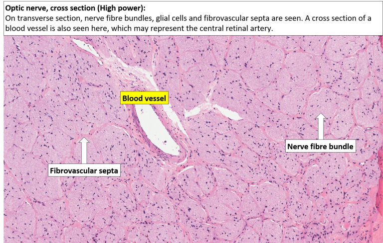 Eye Optic Nerve Nus Pathweb Nus Pathweb