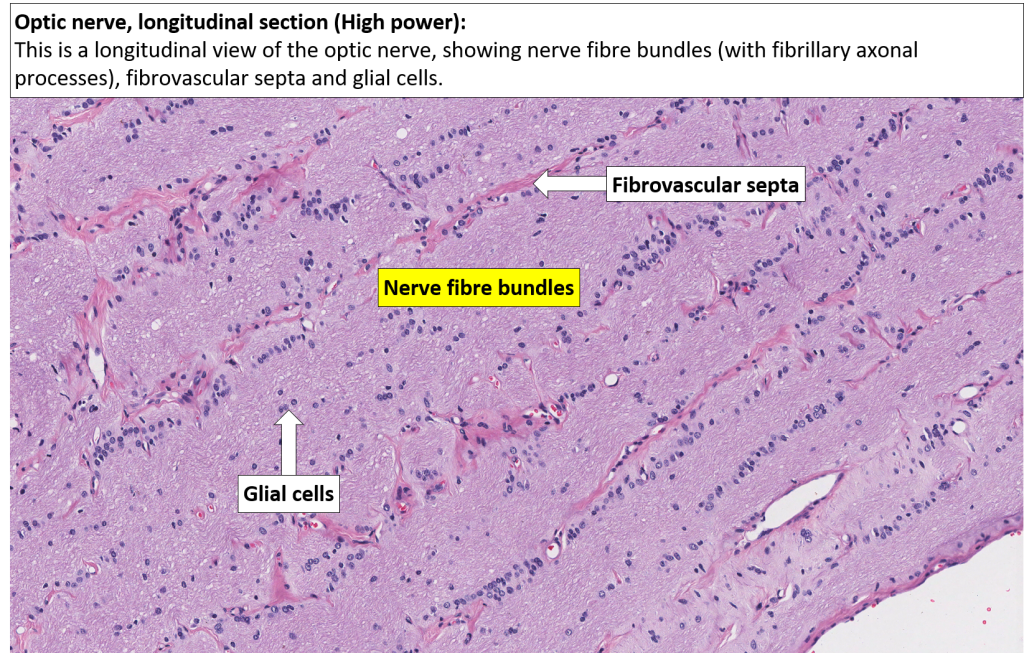 Eye Optic nerve NUS Pathweb NUS Pathweb