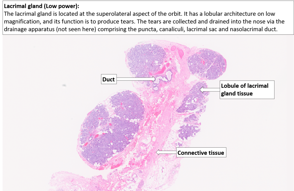 Orbit – Lacrimal gland – NUS Pathweb :: NUS Pathweb