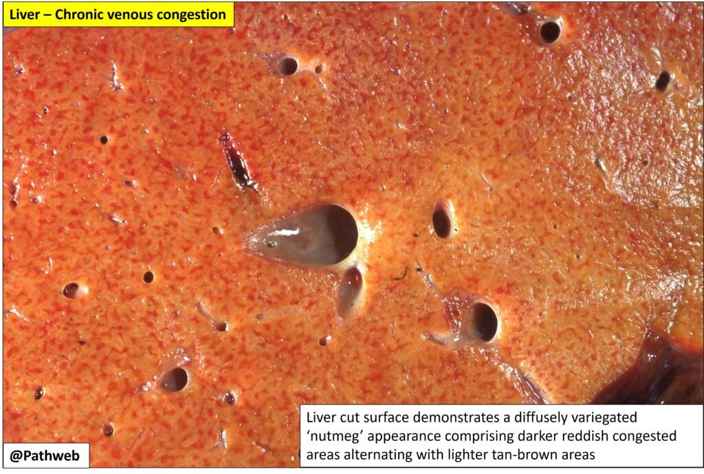 Lung Chronic Venous Congestion (Brown Induration) NUS Pathweb NUS Pathweb