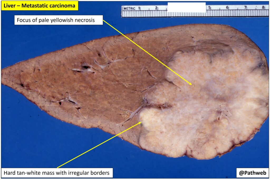 Liver Metastatic Carcinoma Nus Pathweb Nus Pathweb 2637