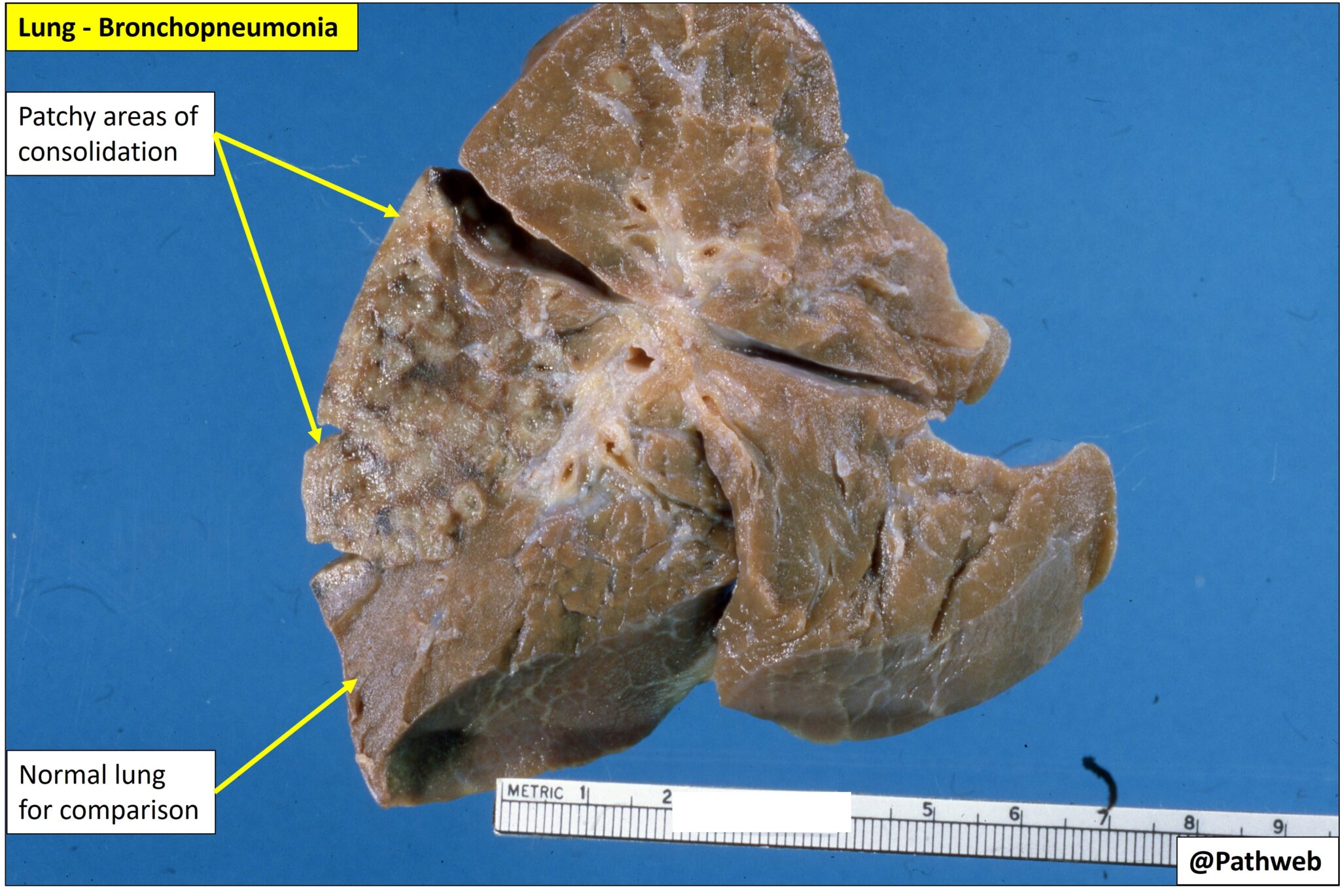 Lung – Bronchopneumonia – NUS Pathweb :: NUS Pathweb